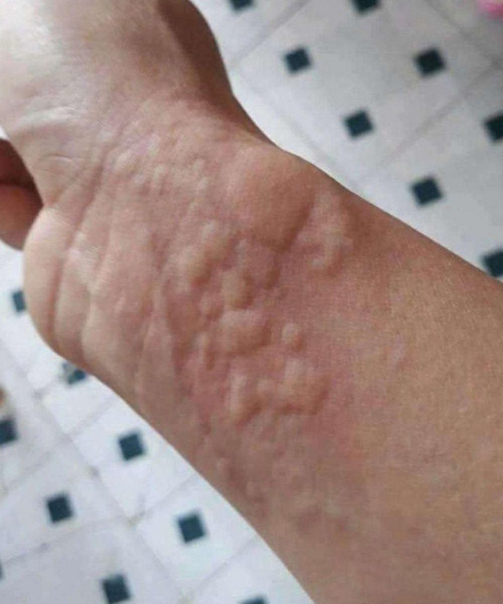 When Hives and Breathing Changes Appear Together